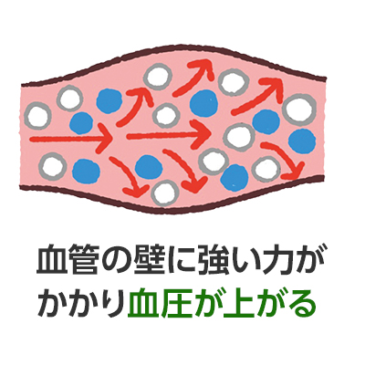 血管の壁に強い力がかかり血圧が上がる