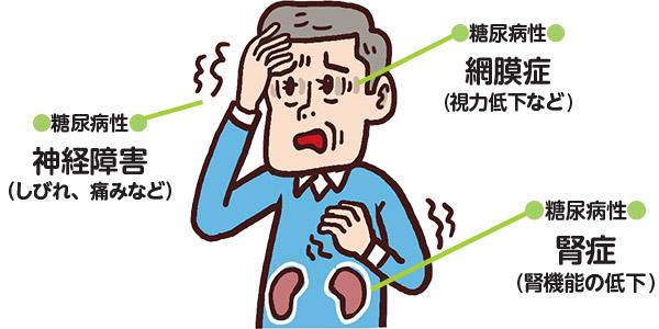 糖尿病性神経障害(しびれ、痛みなど)、糖尿病性網膜症(視力低下など)、糖尿病性腎症(腎機能の低下)